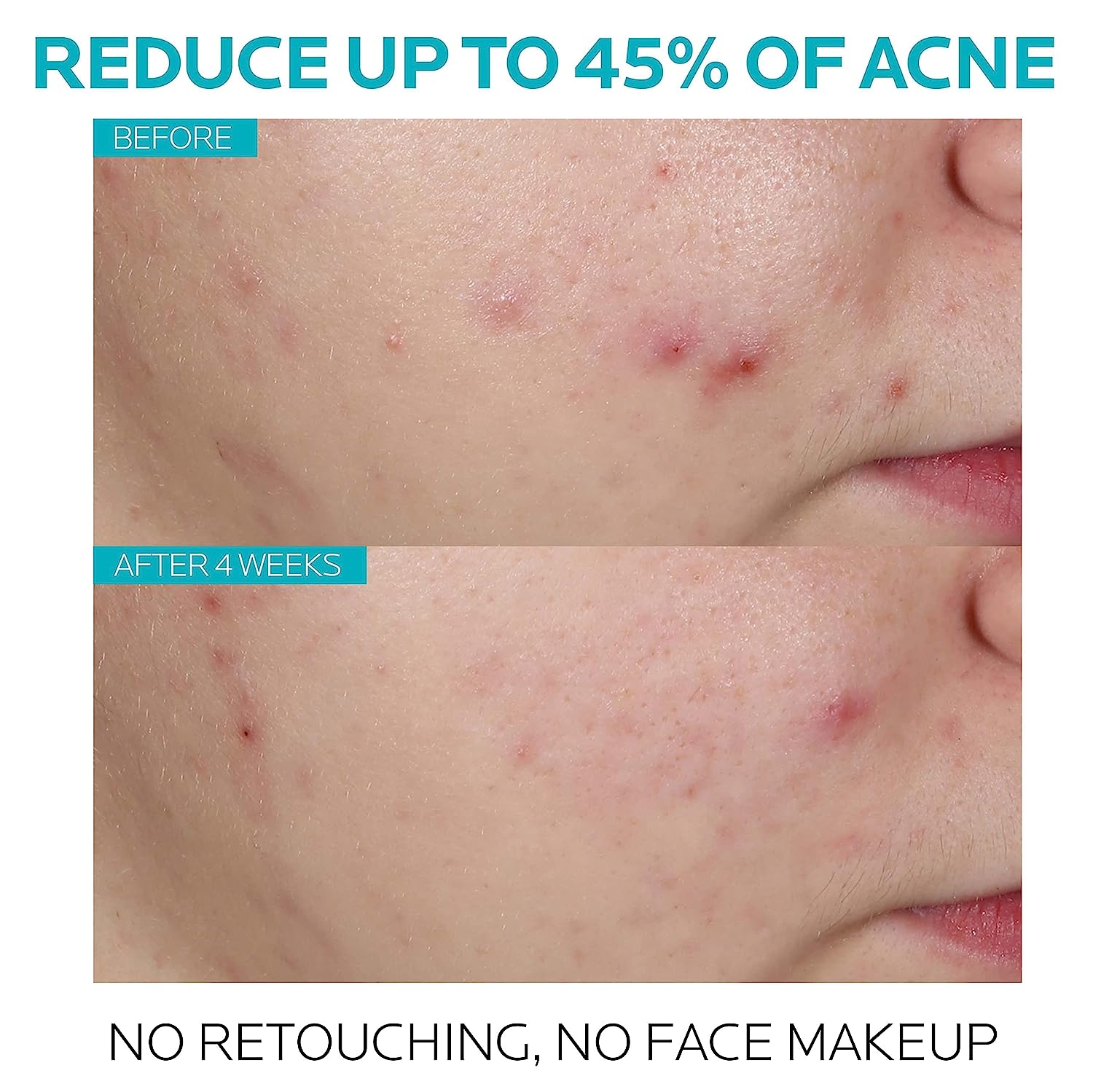 La Roche Posay Effaclar Salicylic Acid Acne Treatment to Minimize Pores, Clear Acne Blemishes and Post Acne Marks